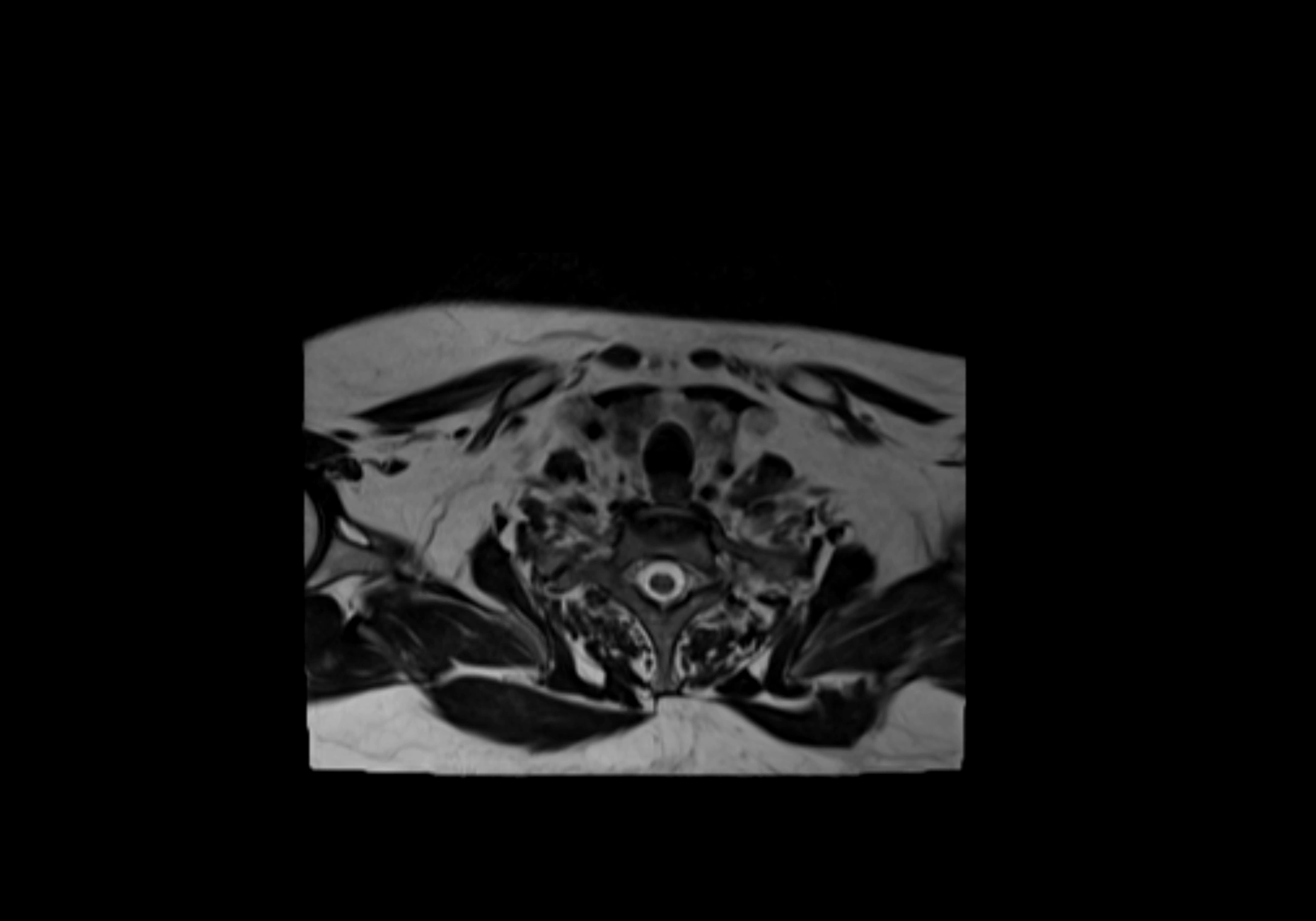 Neck axial  lymph node cross sectional MRI anatomy 3T MRI  image-img-00001-00088.webp